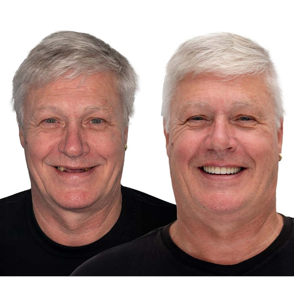 Removable Dentures with Flexible Cushion Grip and Storage Case Full Arch Temporary - Image 11