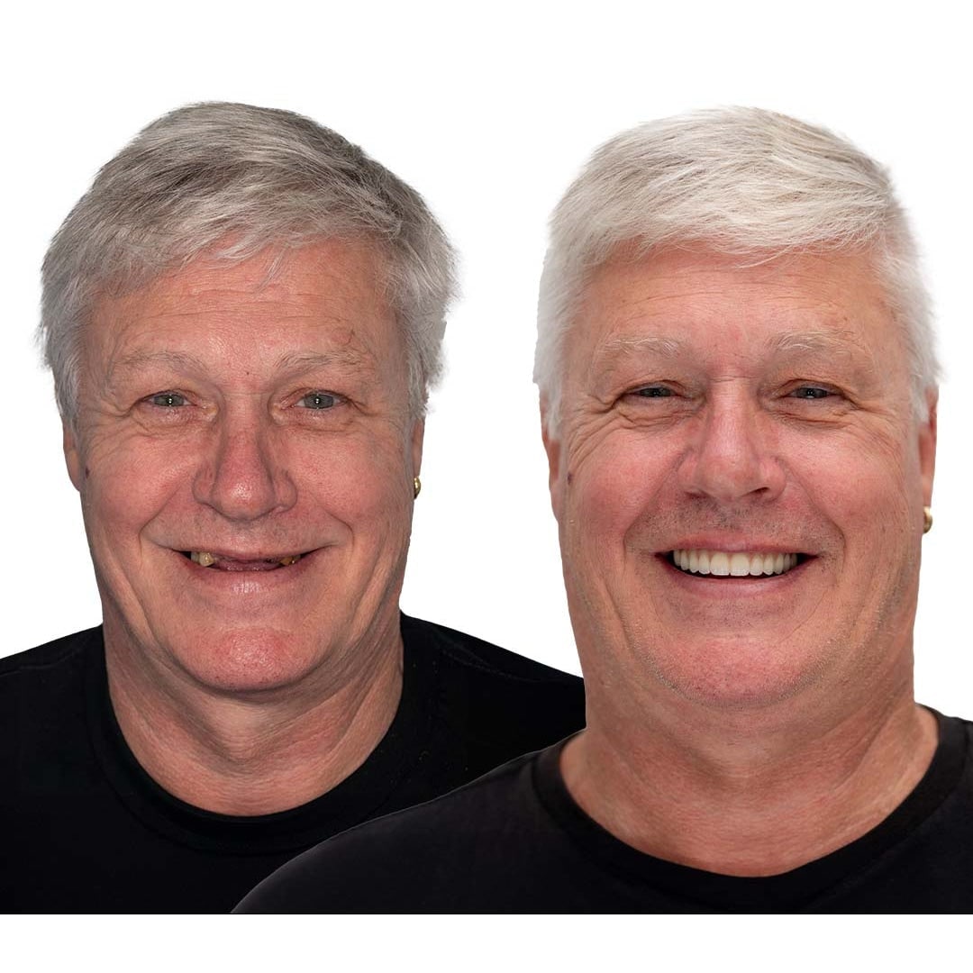 Removable Dentures with Flexible Cushion Grip and Storage Case Full Arch Temporary - Image 11