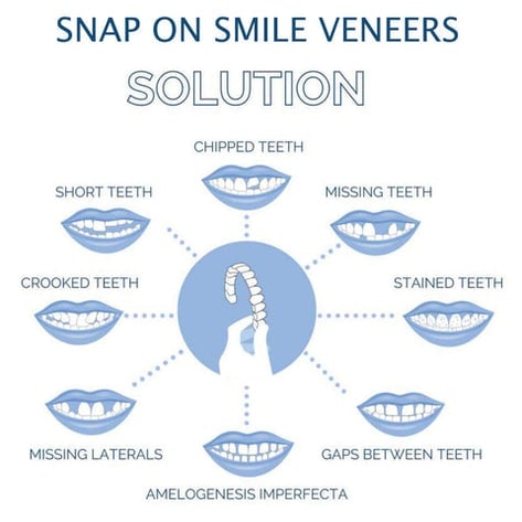 Snap on Veneers Cosmetic Dental Temporary Tooth Covers Upper and Lower Set - Image 6